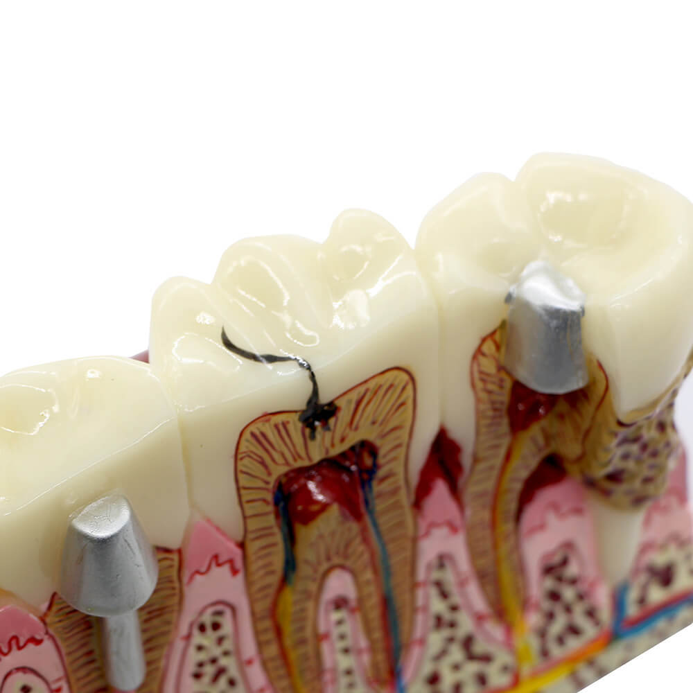 Dental Anatomy of Dental Caries Plastic Teeth Model Demo Communication