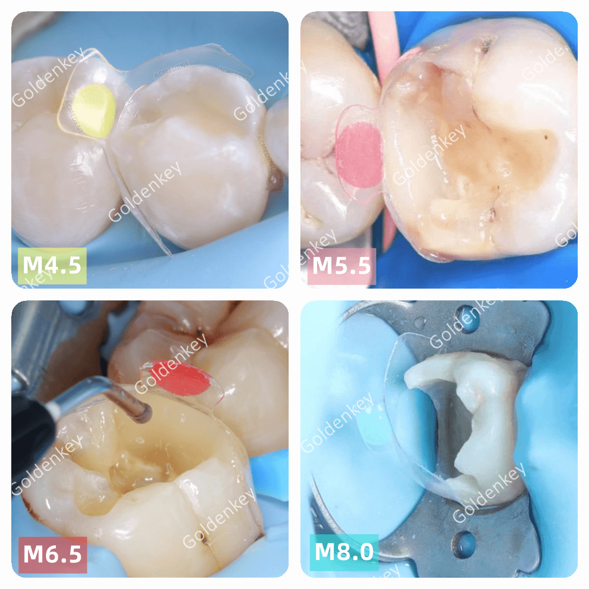 Dental Clear Matrix Posterior Transparent BT Matrices Fits Bioclear 4.5/5.5/6.5