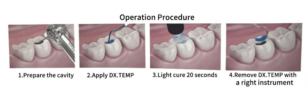 DX.TEMP Light Cure Temporary Composite – 2.5g Syringe Transparent Color Dental