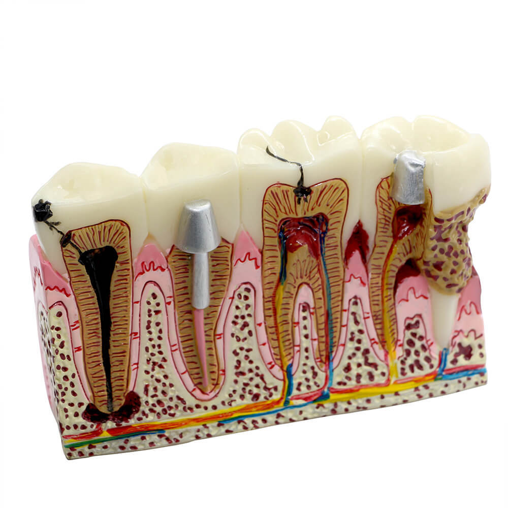 Dental Anatomy of Dental Caries Plastic Teeth Model Demo Communication