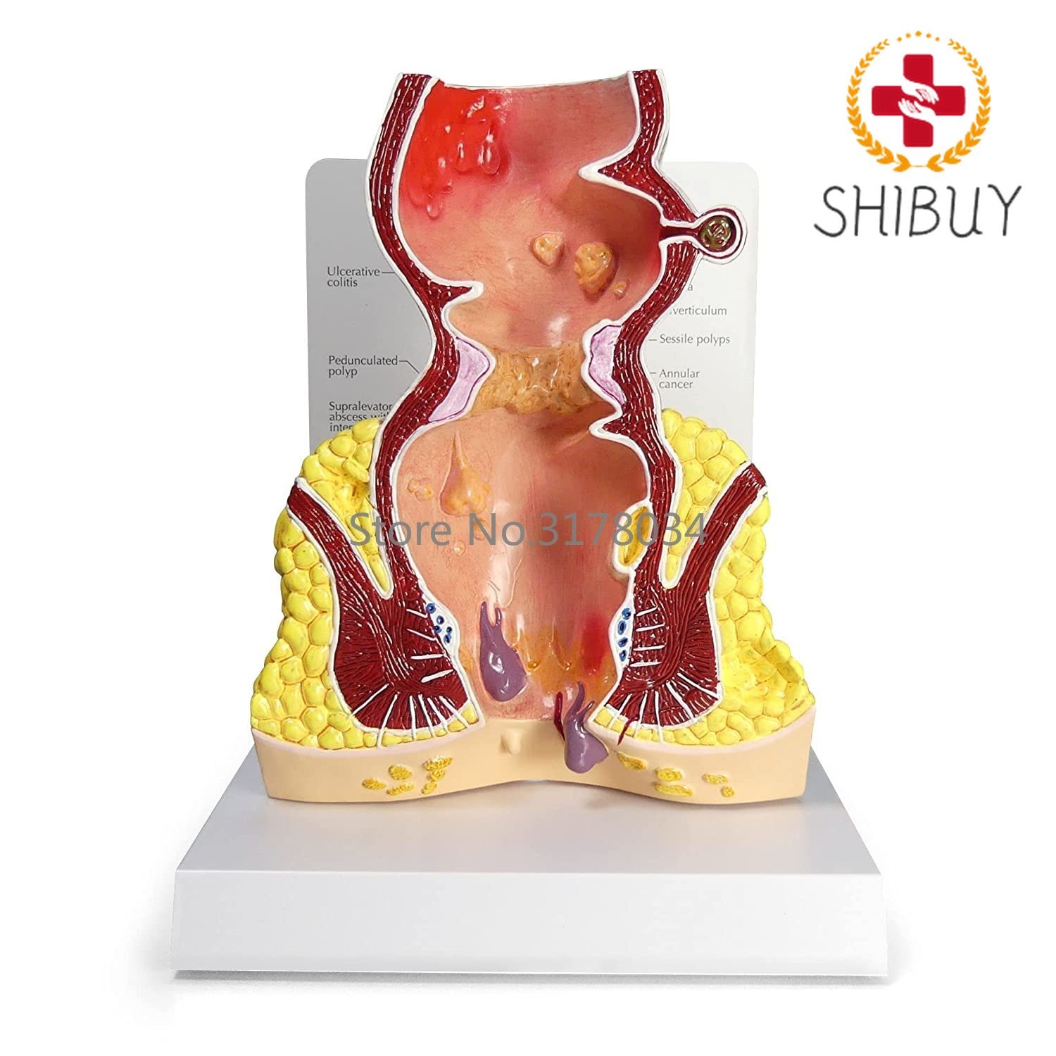 Rectum Model Human Body Anatomy Replica of Rectum W/Common Pathologies Model