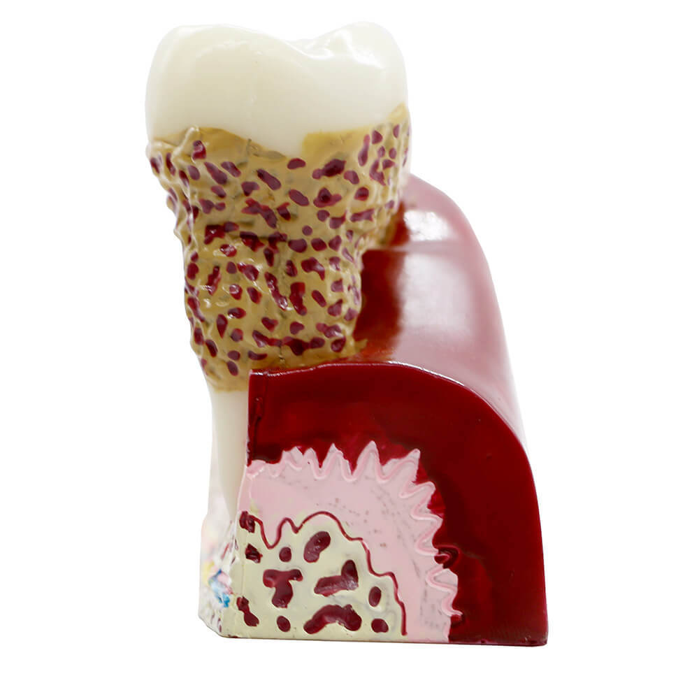 Dental Anatomy of Dental Caries Plastic Teeth Model Demo Communication