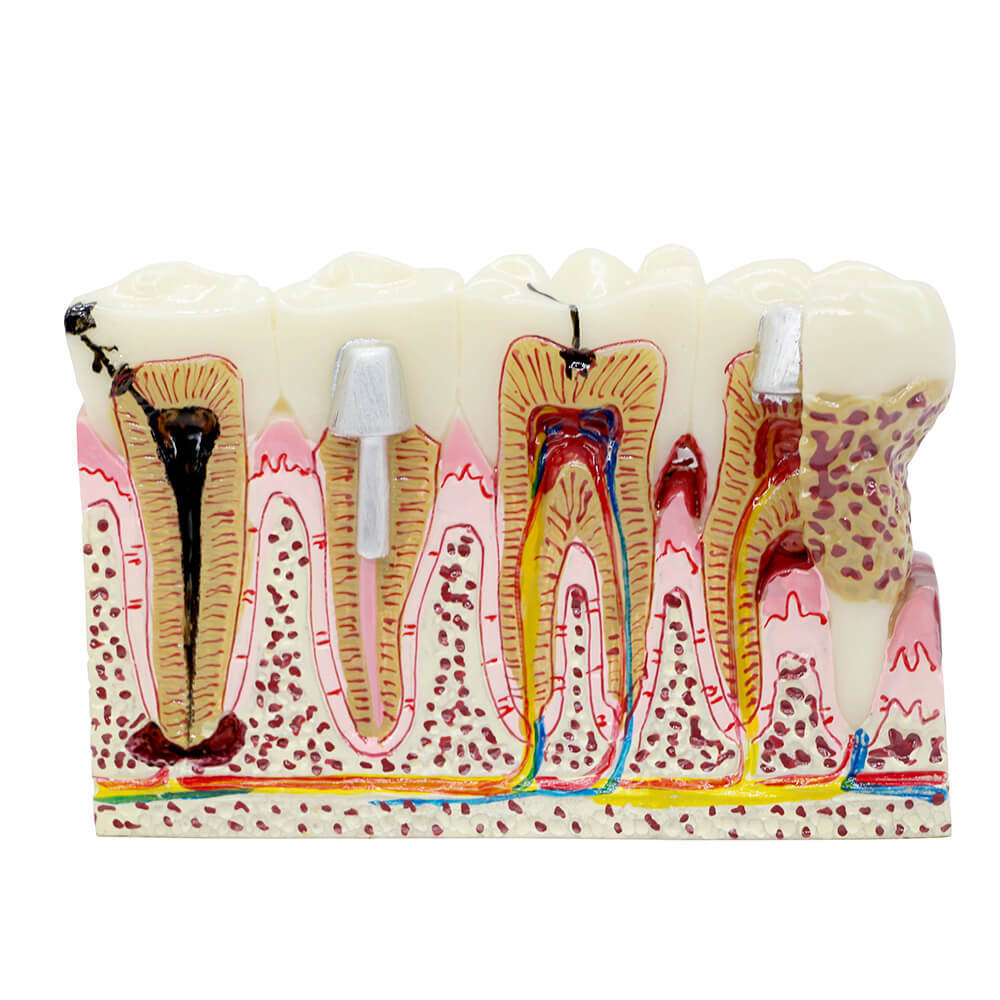 Dental Anatomy of Dental Caries Plastic Teeth Model Demo Communication